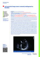 prikaz prve stranice dokumenta Left ventricular benign tumors commonly misdiagnosed as thrombus